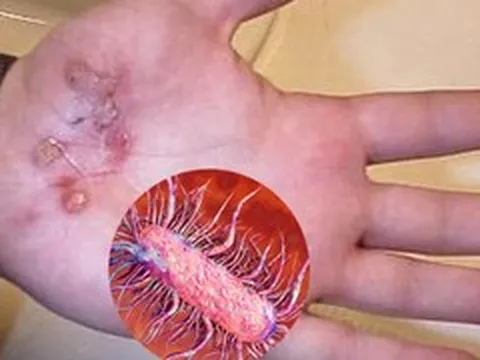 Suýt mất mạng do vi khuẩn 'ăn thịt người' tấn công