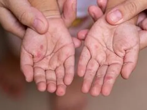 Ba tháng đầu năm ghi nhận gần 25.000 ca tay chân miệng, Bộ Y tế chỉ đạo khẩn