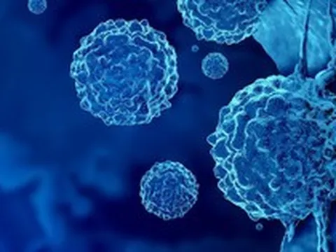 Loại ung thư đứng thứ 2 về tỉ lệ tử vong tại Việt Nam: 5 dấu hiệu sớm nhất ai cũng nên biết