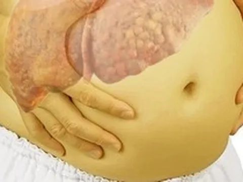 Nhiều người Việt xơ gan, ung thư gan chỉ vì dùng 1 thứ tưởng "lành tính": Bác sĩ cảnh báo