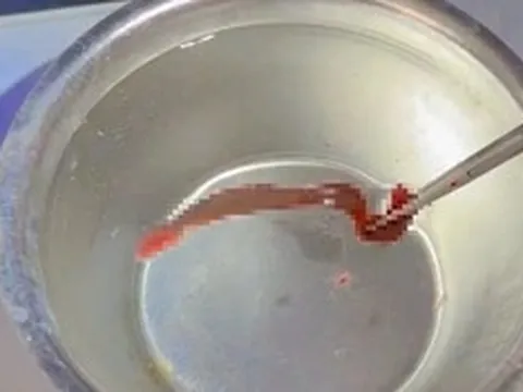 Người đàn ông 53 tuổi chảy máu mũi liên tục, bác sĩ phát hiện ra thứ "đáng sợ" ẩn náu bên trong