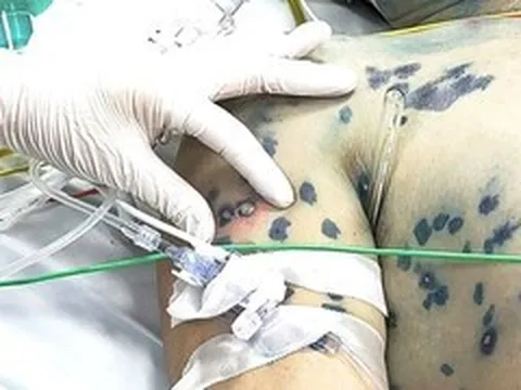 Khuyến cáo người trưởng thành không chủ quan với thuỷ đậu