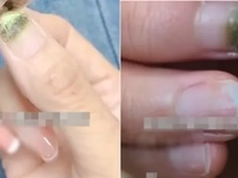 Người phụ nữ bị mốc móng tay sau khi làm nails, bác sĩ lên tiếng cảnh báo