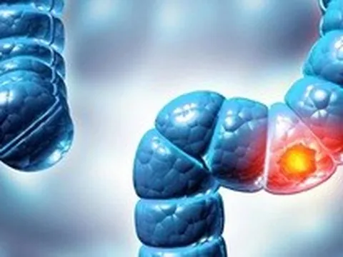 Phát hiện virus mới liên quan loại bệnh ung thư phổ biến