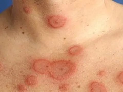 Căn bệnh nguy hiểm chỉ 10% được chẩn đoán sớm, có người vài năm mới phát hiện