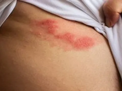 Bị giời leo bôi thuốc gì cho nhanh khỏi?