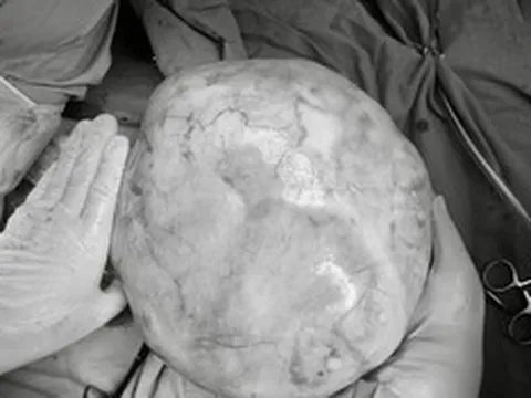 Bé gái 14 tuổi bụng to bất thường, bố mẹ sốc khi phát hiện bí mật "đáng sợ" bên trong