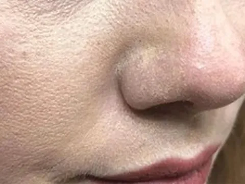 Vì sao thoa kem chống nắng bị mốc trắng, xử lý thế nào?