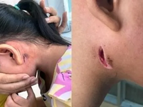 Đồng Nai phát hiện ca nhiễm khuẩn Whitmore đầu tiên
