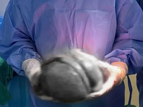Đau bụng âm ỉ suốt nhiều tháng, người đàn ông sốc nặng khi phát hiện thứ "đáng sợ" trong bụng