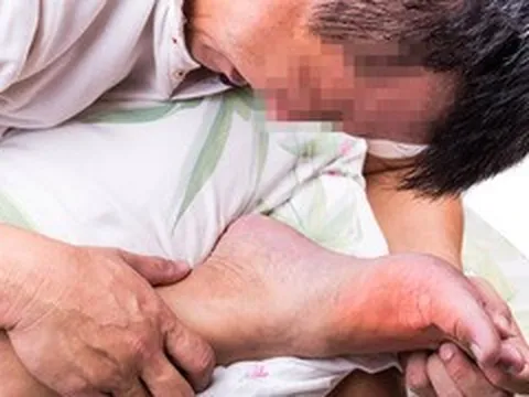 Cứ nghĩ bong gân nên tự xoa bóp, người đàn ông 38 tuổi ngỡ ngàng khi biết bị gout