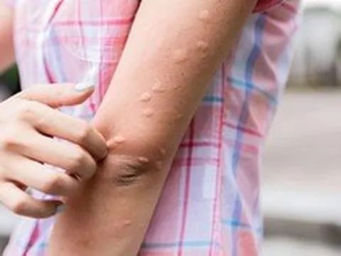 Các phản ứng dị ứng và miễn dịch sau tiêm vắc-xin: Bác sĩ Bệnh viện Bạch Mai khuyên "hiểu đúng"