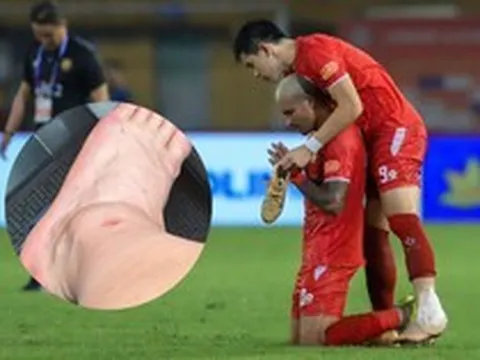 Đình Bắc lộ ảnh cổ chân sưng biến dạng sau trận vô địch V.League cùng CLB CAHN