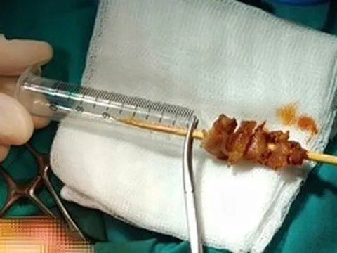 Cuộc hội chẩn xuyên đêm cứu bé gái gặp tai nạn hi hữu do que xiên thịt