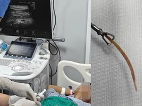 Đau bụng suốt 10 ngày, bất ngờ phát hiện tăm tre đâm thủng đại tràng