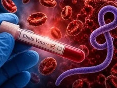 Bác sĩ cảnh báo triệu chứng của Ebola dễ bị bỏ qua