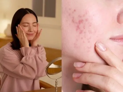 Tưởng chăm da kỹ, ai ngờ 5 thói quen này lại khiến lỗ chân lông nở to, da xuống cấp nhanh chóng