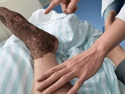 Bị rắn độc cắn khi đang cấy lúa, người đàn ông làm 1 việc khiến bác sĩ khen ngợi