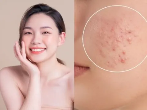 Da dễ sạm, đổ dầu và nổi mụn mùa Hè? Đây là những cách giúp làn da sáng khỏe hơn mỗi ngày