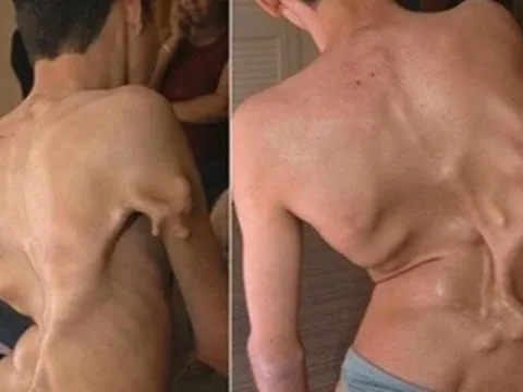 Bé gái 12 tuổi mắc hội chứng "người hóa đá" cực hiếm, cả triệu người mới có một ca