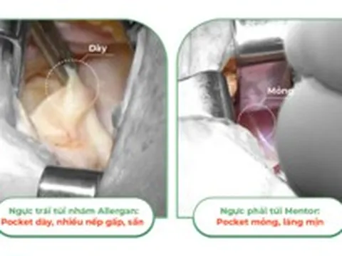 Khác nhau giữa túi ngực nhám và túi ngực trơn trên cùng 1 cơ thể