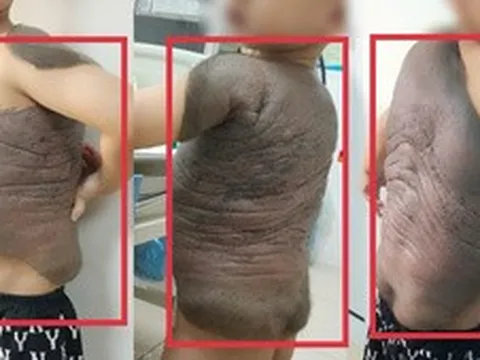 Mắc căn bệnh lạ, bé 7 tuổi phải đeo 'mai rùa' từ khi sinh ra
