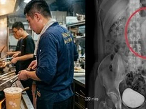 Nam đầu bếp 32 tuổi phù thận cấp tính vì 1 thói quen uống nước không ít người vẫn làm mỗi ngày