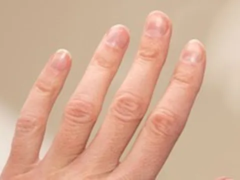 Kiểm tra móng tay ngay xem có dấu hiệu này không - nếu có phải đi khám!