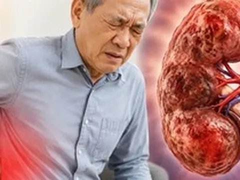 Bác sĩ chỉ: 6 DẤU HIỆU cảnh báo suy thận, nhưng dễ bị người Việt nhầm với vấn đề tuổi tác và mệt mỏi