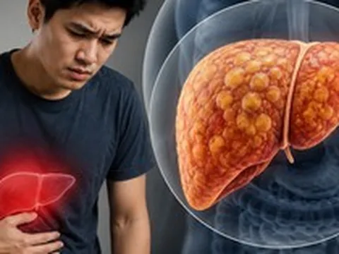 Gan nhiễm mỡ "ghé thăm" ngày càng nhiều người trẻ: Nếu có 7 THÓI QUEN này, bạn cần thay đổi ngay trước tuổi 40