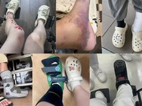 Lời khuyên cho những người thích đi dép sục, dép "kiểu crocs"