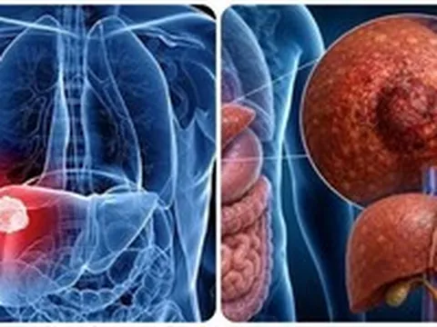 9 triệu chứng ung thư gan giai đoạn đầu